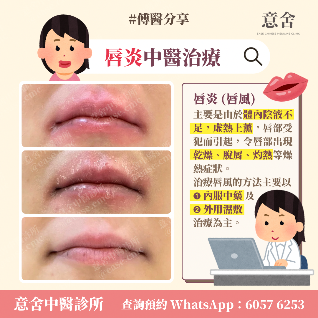 慢性唇炎根治有可能嗎?中醫西醫治療方法一次看!