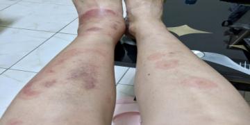 異位性皮膚炎照片看這裡!3招教你快速舒緩症狀