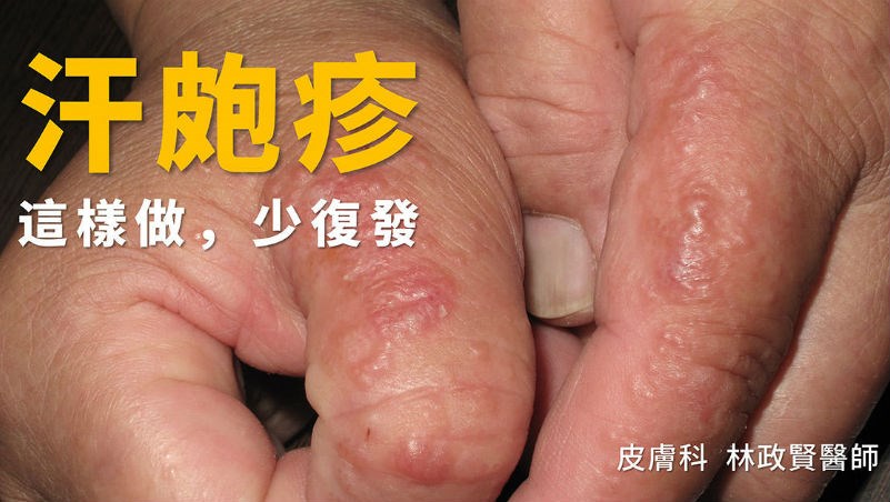 寶寶手腳長一粒一粒的怎麼消?醫師教你止癢!
