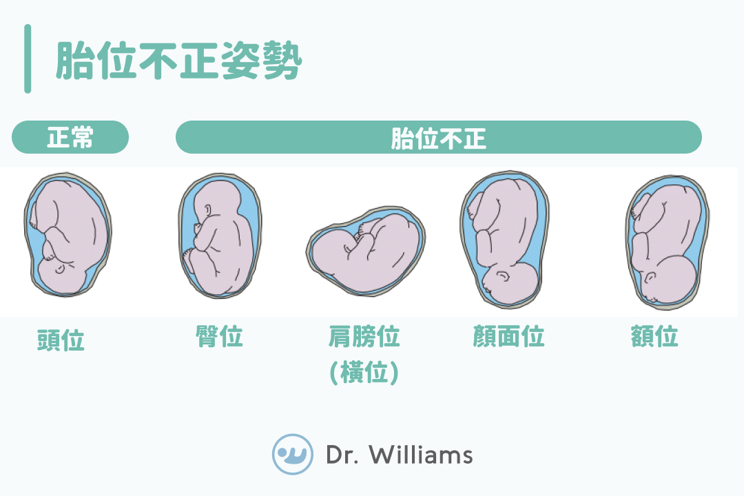 胎兒位置異常怎麼辦?何時需要就醫?