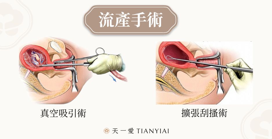真空吸引術後要注意什麽?保養細節大公開!