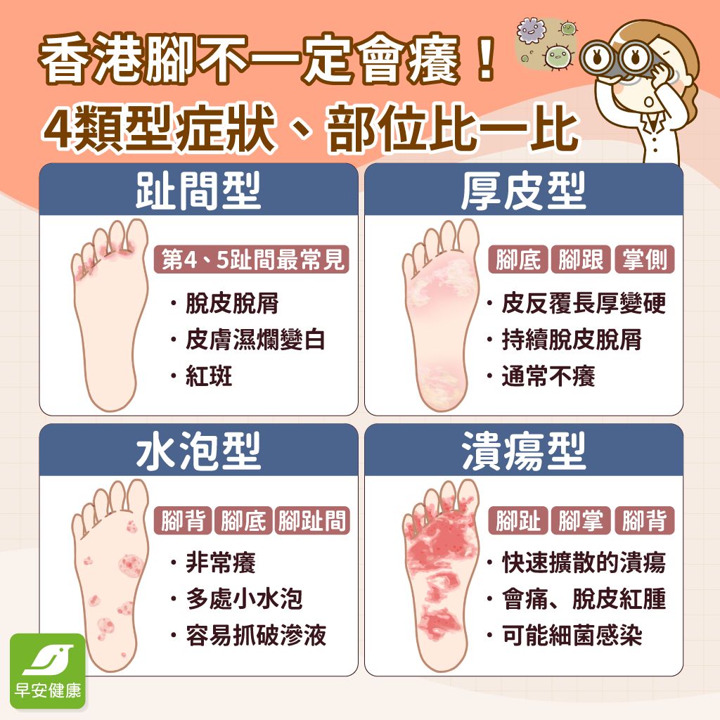 小孩香港腳初期症狀有哪些?及早發現治療!