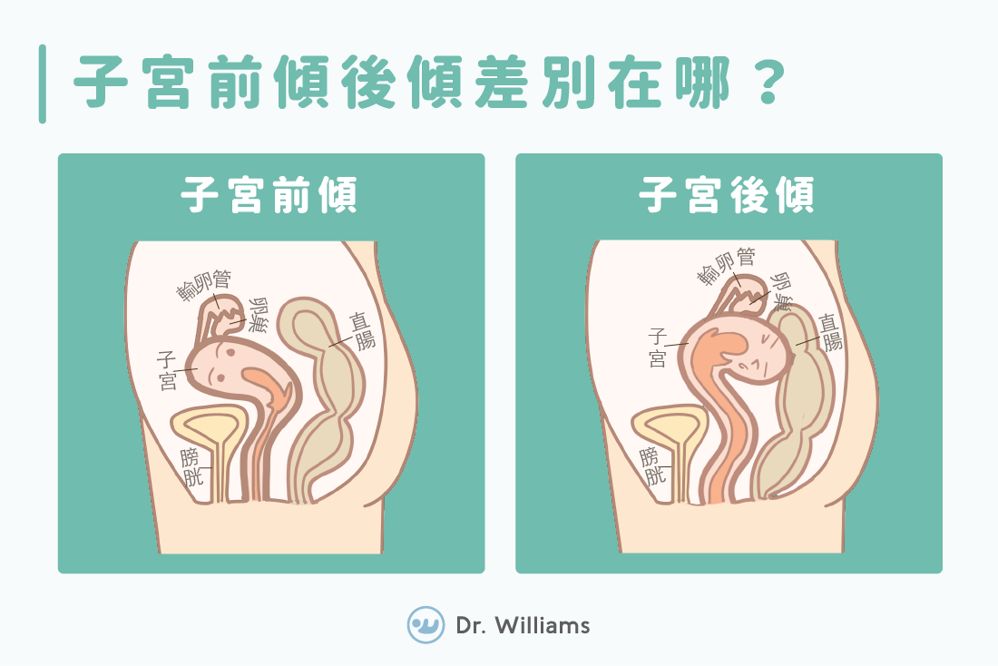 子宮前傾怎麼辦?別擔心,簡單方法教你改善!