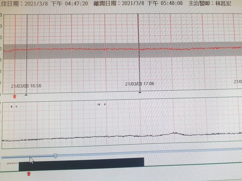胎心監測:胎兒心跳超過160,何時該就醫檢查?